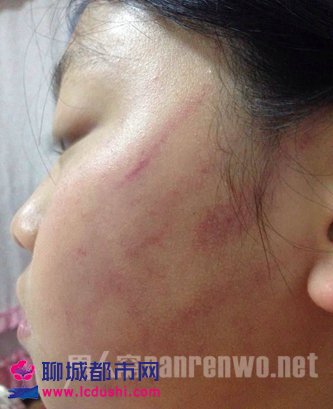 在九江怡康小学读四年级的女儿,被学校老师扇巴掌,脸上留下了几个手掌